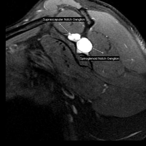 Figure 3 for case Notch ganglion cysts